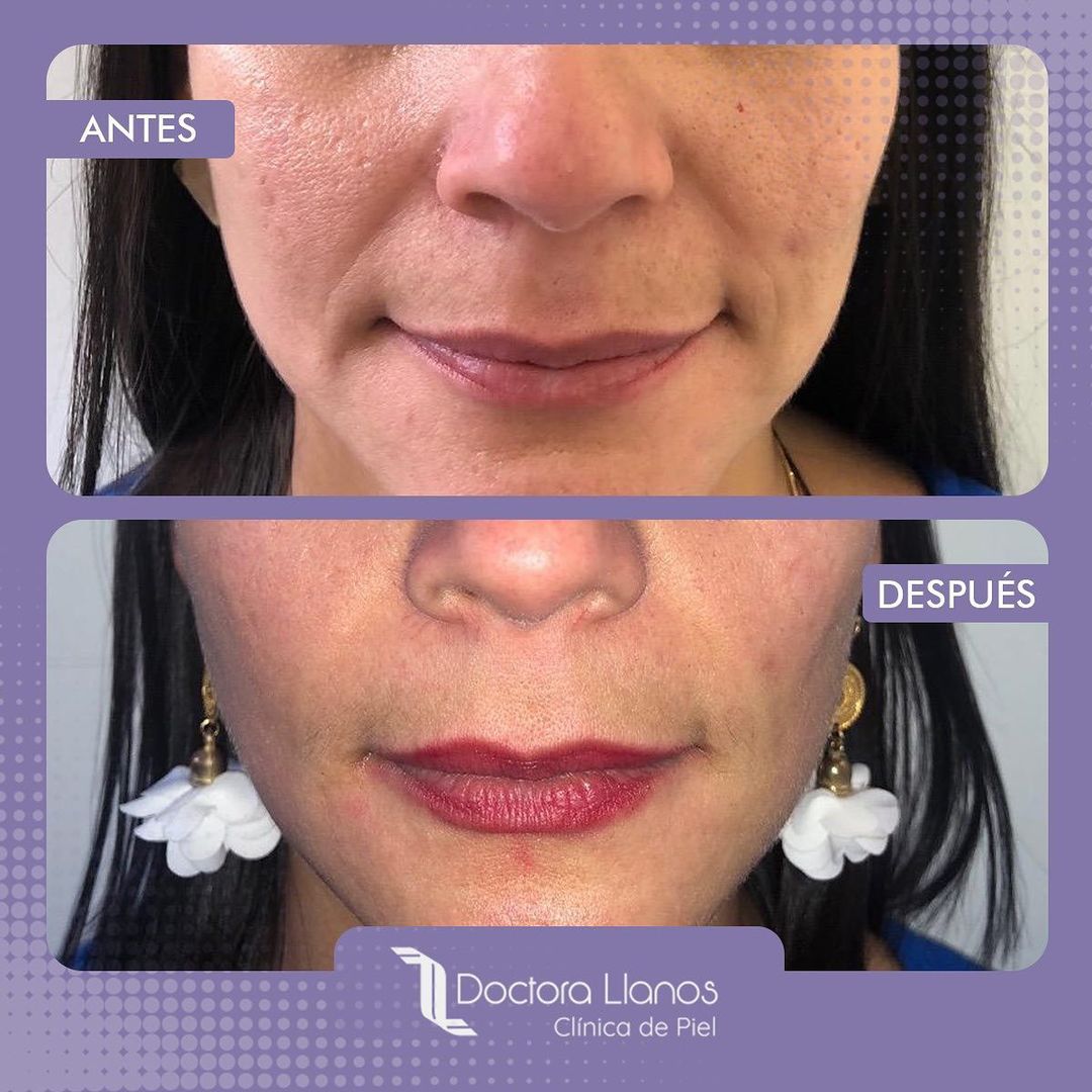 Tratamiento de Botox para la Cara Antes y Después