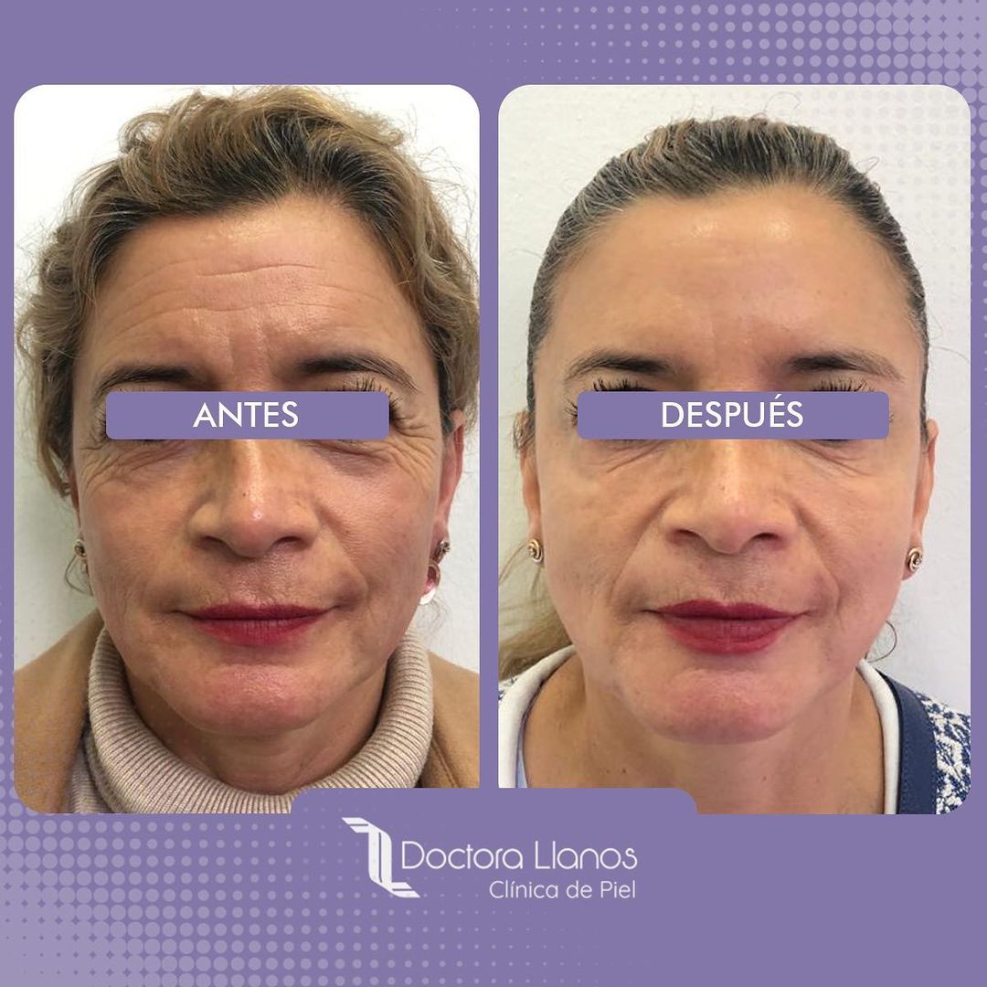 Antes y Después Tratamiento de Botox para la Cara