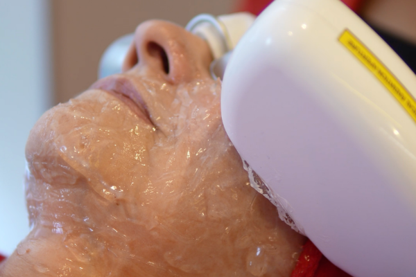 Termolifting facial con Zaffiro